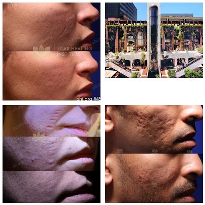 Scar Healing Institute - Best Acne Scar Treatment Center