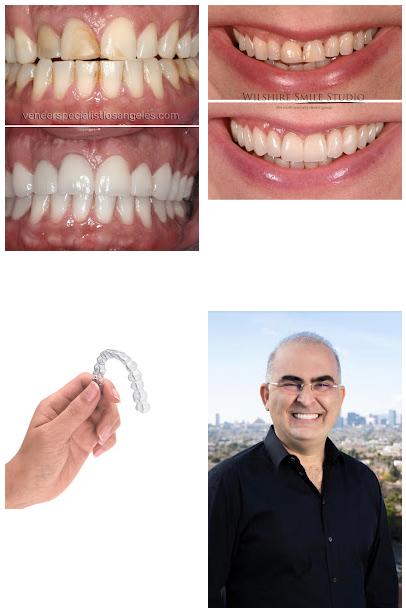 Dental Veneers Specialist On Wilshire